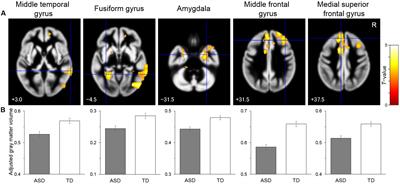 Reduced Gray Matter Volume in the Social Brain Network in Adults with Autism Spectrum Disorder